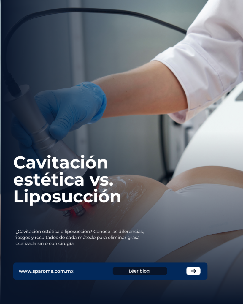 Cavitación estética vs. Liposucción