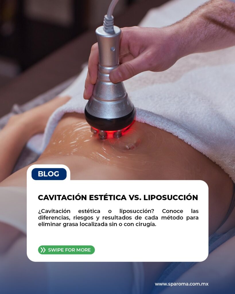 Cavitación estética vs. Liposucción